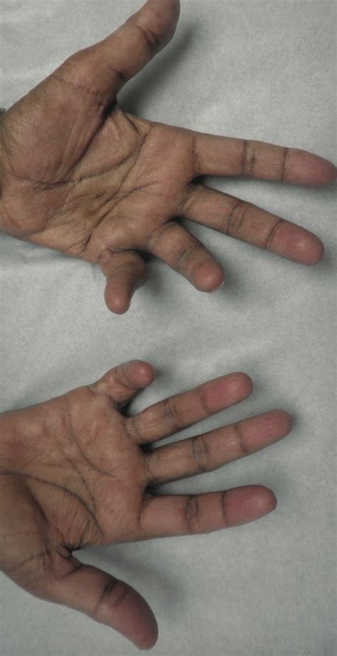 Can You Identify This Patient’s Bilateral Hand Deformities and Loss of ...