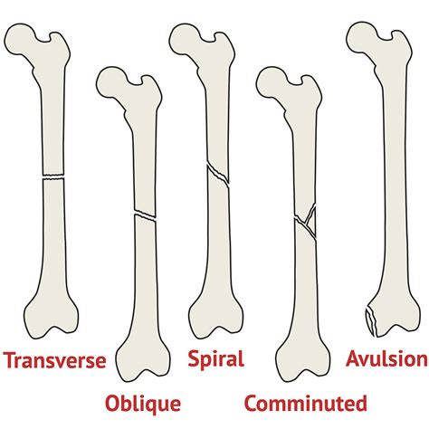 Types of Fracture | Ortho X-Ray - MedSchool