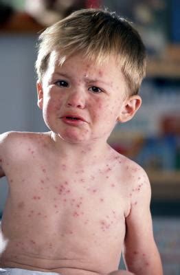 Fever and Rash in Toddlers - New Kids Center