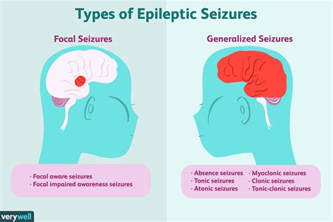 Epilepsy: Overview and More