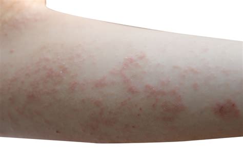 Human Itch Mite Rash - Scabies Treatments