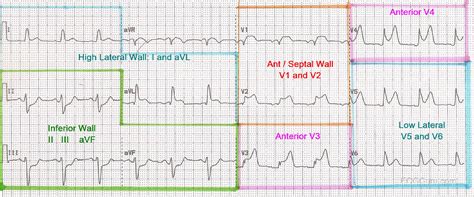 Mapped 12-Lead ECG | ECG Guru - Instructor Resources