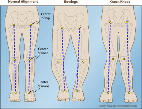 Bowlegs | International Center for Limb Lengthening