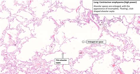 Emphysema Histology