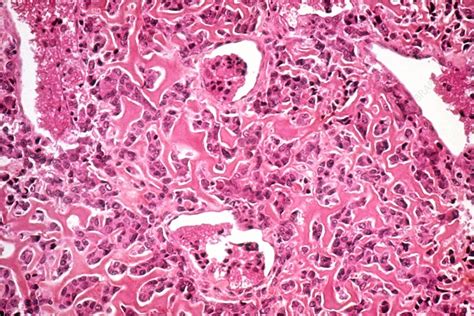 Osteosarcoma Histology