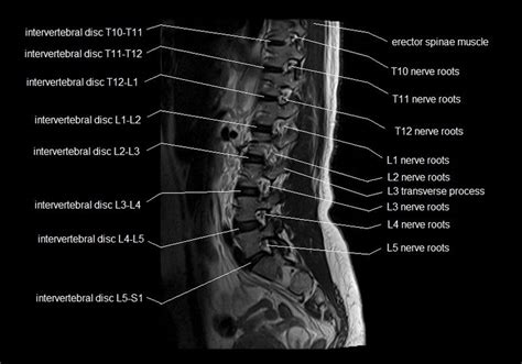 Mri spine anatomy free mri lumbar spine sagittal cross sectional ...