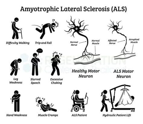 ALS - CiorstainAmi