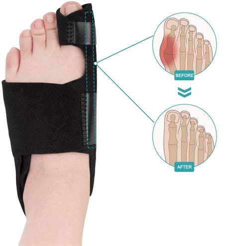 Bunion Splint for Severe Bunion - ComfyFootgear