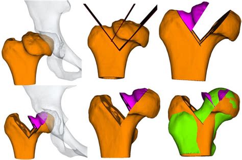 Pre-operative computerized planning simulation of the femoral head ...