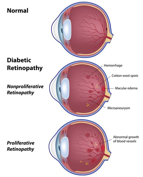 diabetic retinopathy laser treatment recovery time - lockheart-grieshaber