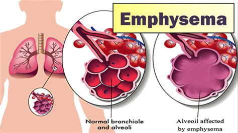 Emphysema - Symptoms And Causes | POSTEEZY