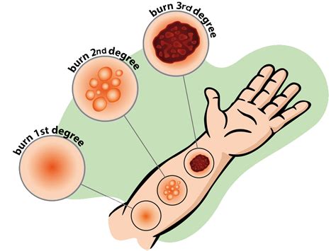 First Aid for Burns: Classification and Treatment - Brisbane First Aid