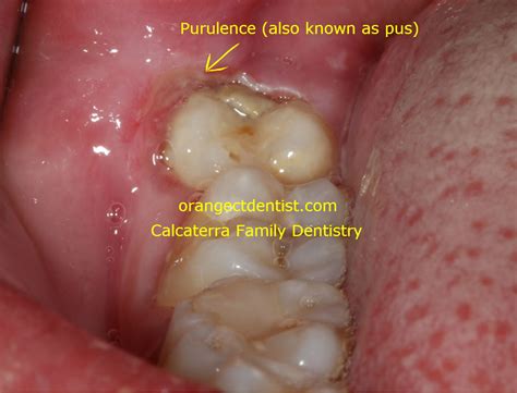 Can You Get Pericoronitis After Wisdom Teeth Removal - TeethWalls