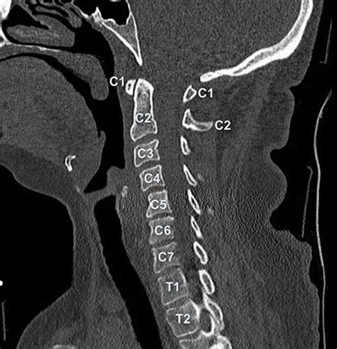 Head and spine anatomy - Radiology Cafe