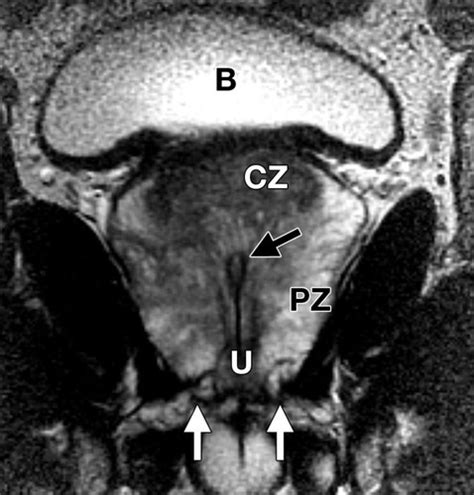 cama Persona a cargo del juego deportivo cama prostate mri anatomy ...