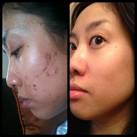 Obagi NuDerm for Acne and Hyperpigmentation – Pixiemama