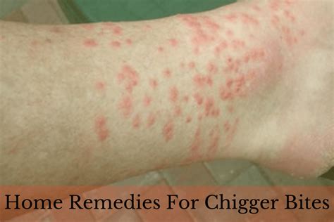 23 Home Remedies To Get Rid Of Chigger Bites At Home