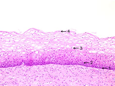 Cervical Ectropion Cervix