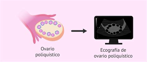 Ecografía de ovario poliquístico