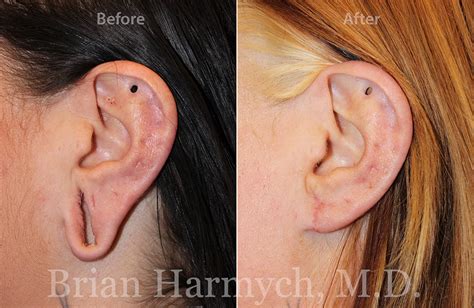 Earlobe Repair | Ear Surgery | Cleveland, OH