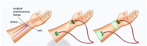 Haemodialysis access with an arteriovenous fistula | Kidney Care UK