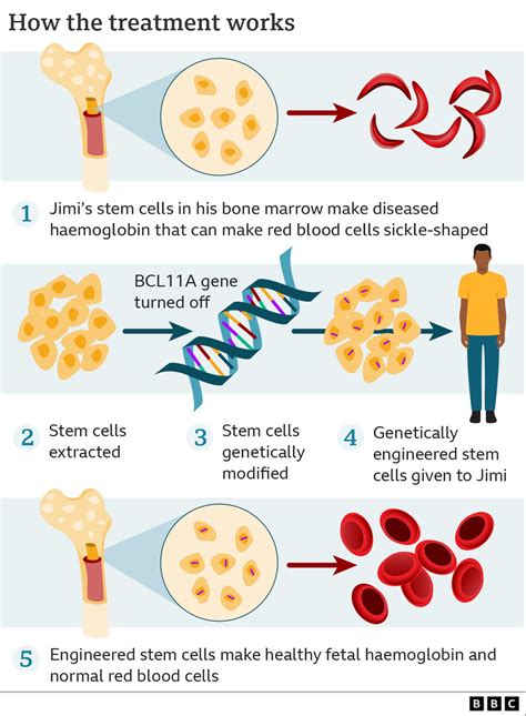 Gene Editing for Sickle Cell Disease Succeeded - Bioinformatics Hub