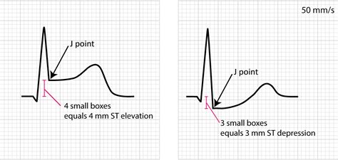 The ST segment: physiology, normal appearance, ST depression & ST ...