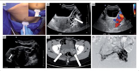 What Is Pelvic Venous Congestion Syndrome Vhc