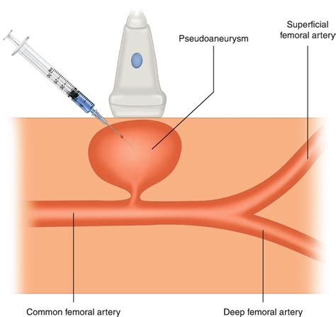 Vascular Procedures | Anesthesia Key