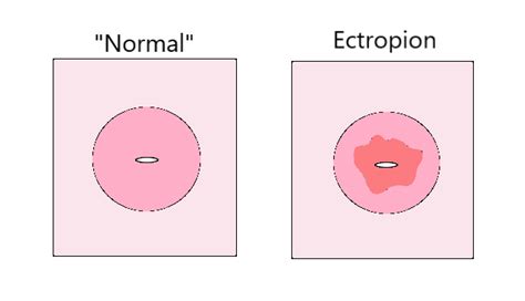 Cervical Ectropion Cervix