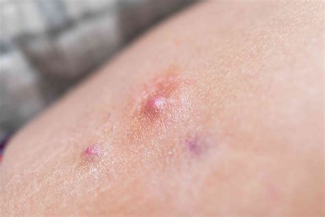 Boil on Inner Thigh: Symptoms, Causes, Treatment