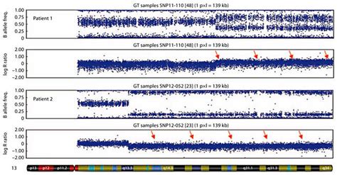 SNP array analysis of chromosome 13. Arrows show the mosaic duplication ...