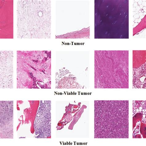 Example osteosarcoma histology synthesized images | Download Scientific ...