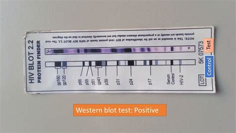 Western blot test: Introduction, Principle, Procedure and Result ...