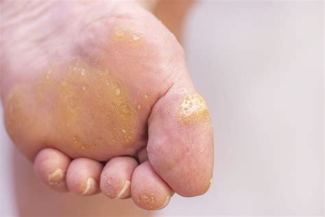 Warts on Your Feet? Symptoms & Causes of Plantar Warts - Foot and Ankle ...