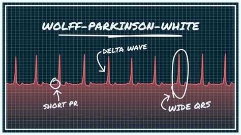 What Wolff-Parkinson-White Syndrome (WPW) Looks Like on Your Watch ECG ...