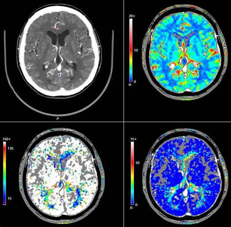 Brain Jack Image: Brain Ct Scan