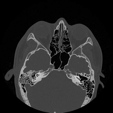 Temporal bone fracture (otic capsule sparing) | Radiology Case ...