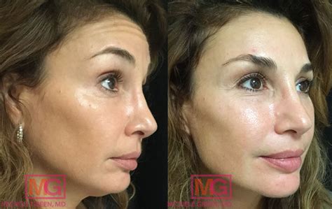 Botox Eye Brow Lift Before And After, Eyebrow Lift Using Botox » Eyelid ...