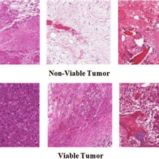 Example osteosarcoma histology synthesized images | Download Scientific ...