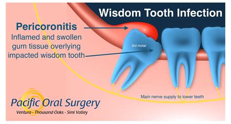 Wisdom Tooth Infection Pacific Oral Surgery - Pacific Oral Surgery