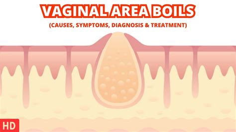 Dealing with Vaginal Area Boils: Tips and Advice for Fast Relief - YouTube