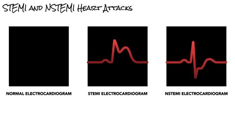 Non-ST Elevation Myocardial Infarction Heart Attack | SCAI - Seconds Count