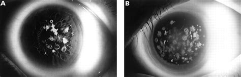 Corneal guttata associated with the corneal dystrophy resulting from a ...