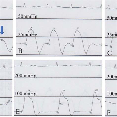 Intracardiac pressure waveform with a Swan-Ganz catheter; (A) the right ...