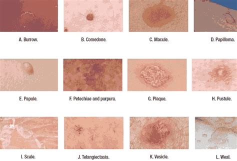 Skin Lesions - Sydney Cosmetic Specialists