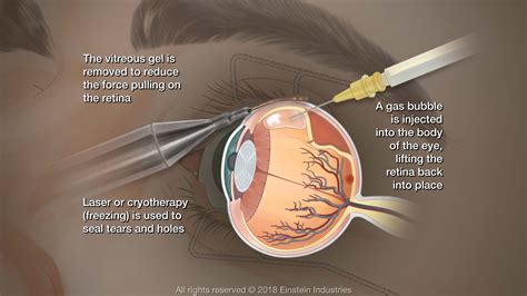 Retinal Detachment Shawnee Mission, KS - Retina Associates, LLC