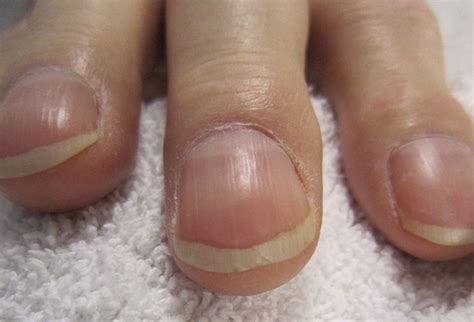 Fingernail and Toenail Abnormalities: Nail the Diagnosis