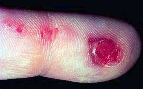 Herpetic Whitlow - Pictures, Treatment, Contagious, Symptoms