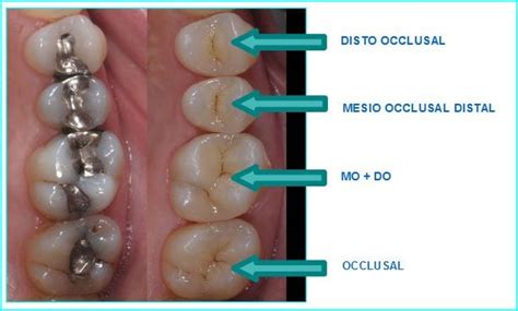 White Fillings - Woodbury Clinic